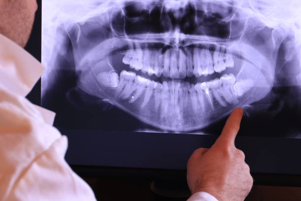 Best Emergency Wisdom Teeth Removal in Durham, CA
